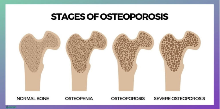 bone density blog graphics_stages of osteoporosis - Maximum Performance